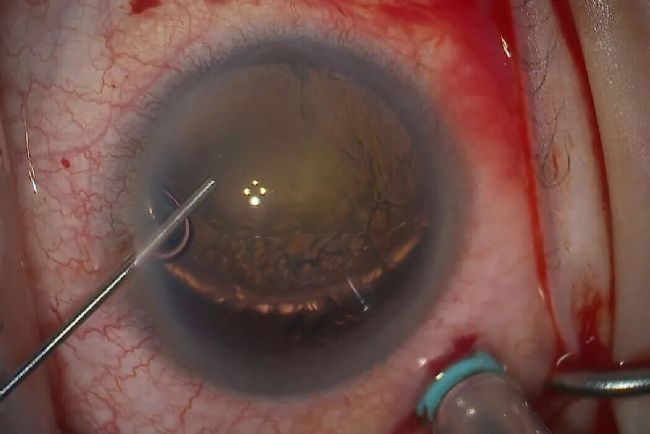 术中 OCT 辅助下的脱位性白内障继发房角闭合病例